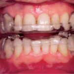 Aparelho intraoral